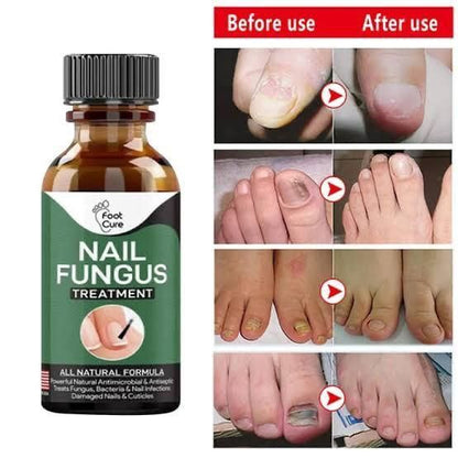 Kick Fungus to the Curb! Effective Nail Treatment (10ml) for Fingernails