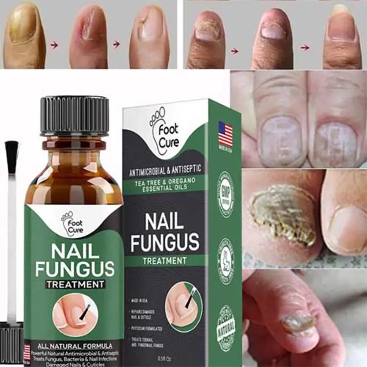 Kick Fungus to the Curb! Effective Nail Treatment (10ml) for Fingernails