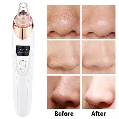 5-in-1 Blackhead Remover Tool: Deep Cleanse & Refine Pores for Glowing Skin